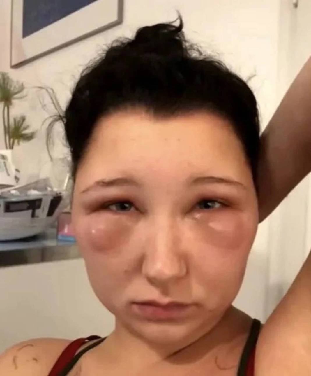 Marketten aldığı ürünle saçını boyadı: Kafası ampul gibi şişti! Yakınları bile tanıyamadı 14